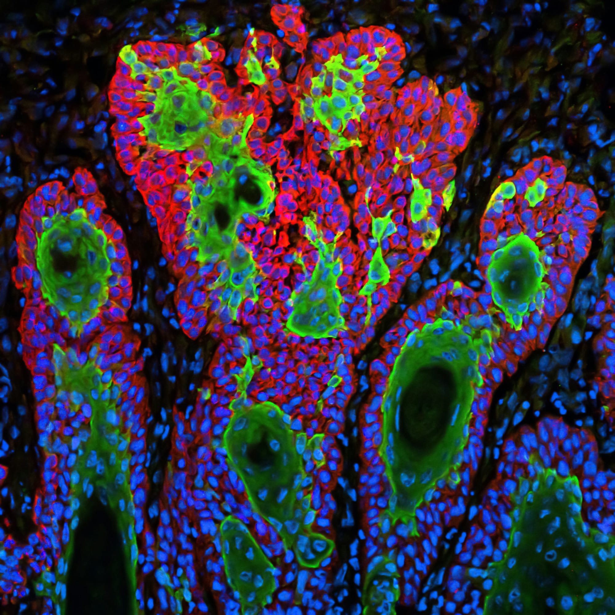 Artificial intelligence in skin cancer diagnosis: Improving diagnostics and reducing health disparity