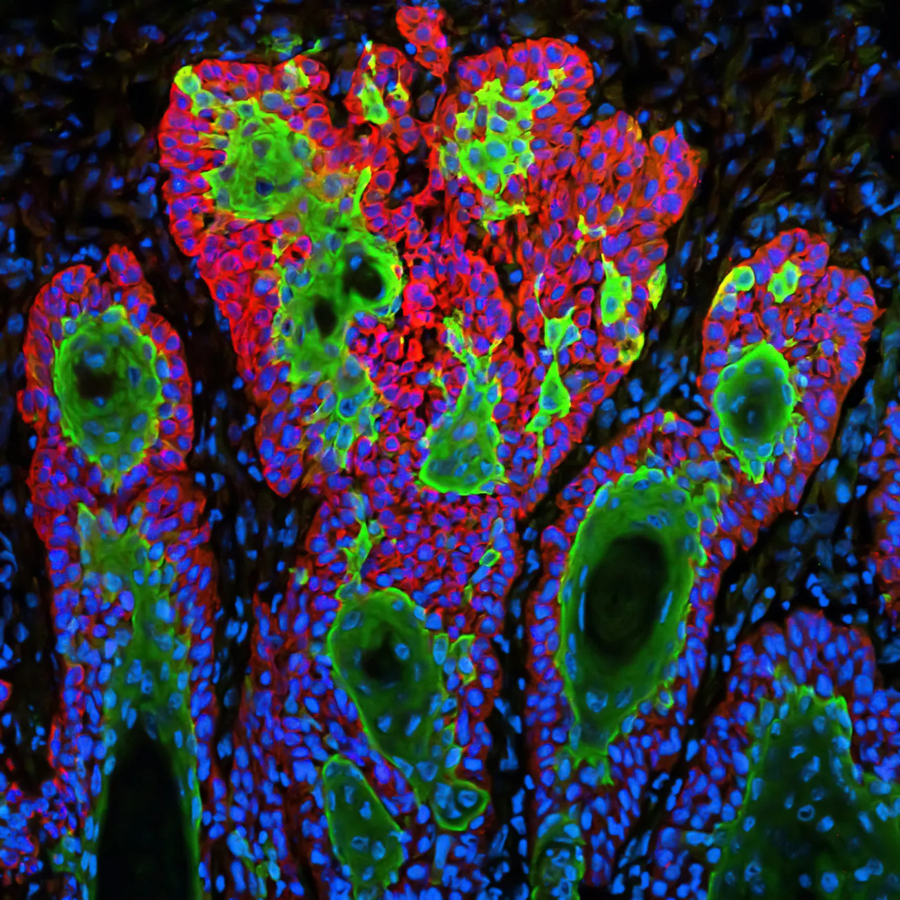 Artificial intelligence in skin cancer diagnosis: Improving diagnostics and reducing health disparity