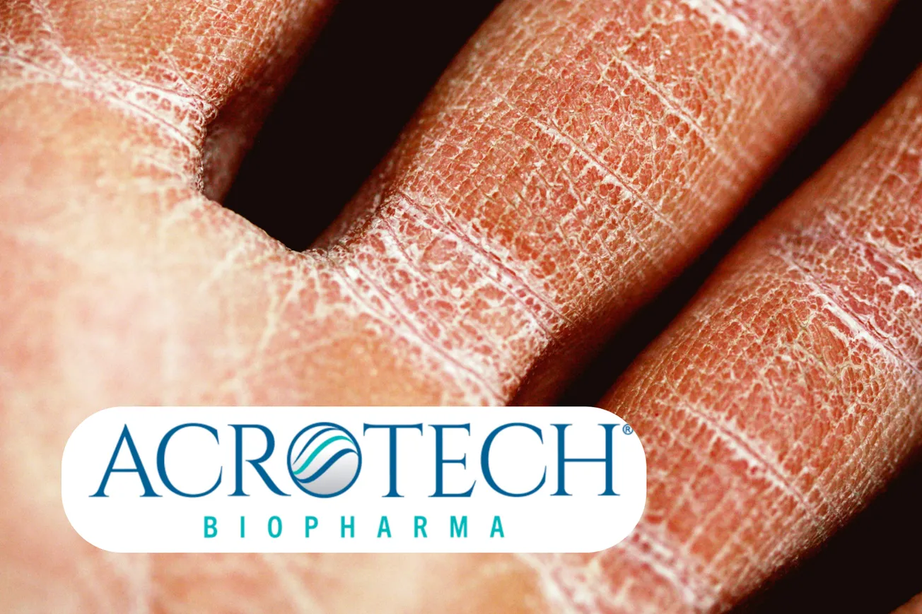 Acrotech Biopharma brings a new topical PDE4 option - Adquey - into a crowded eczema market.