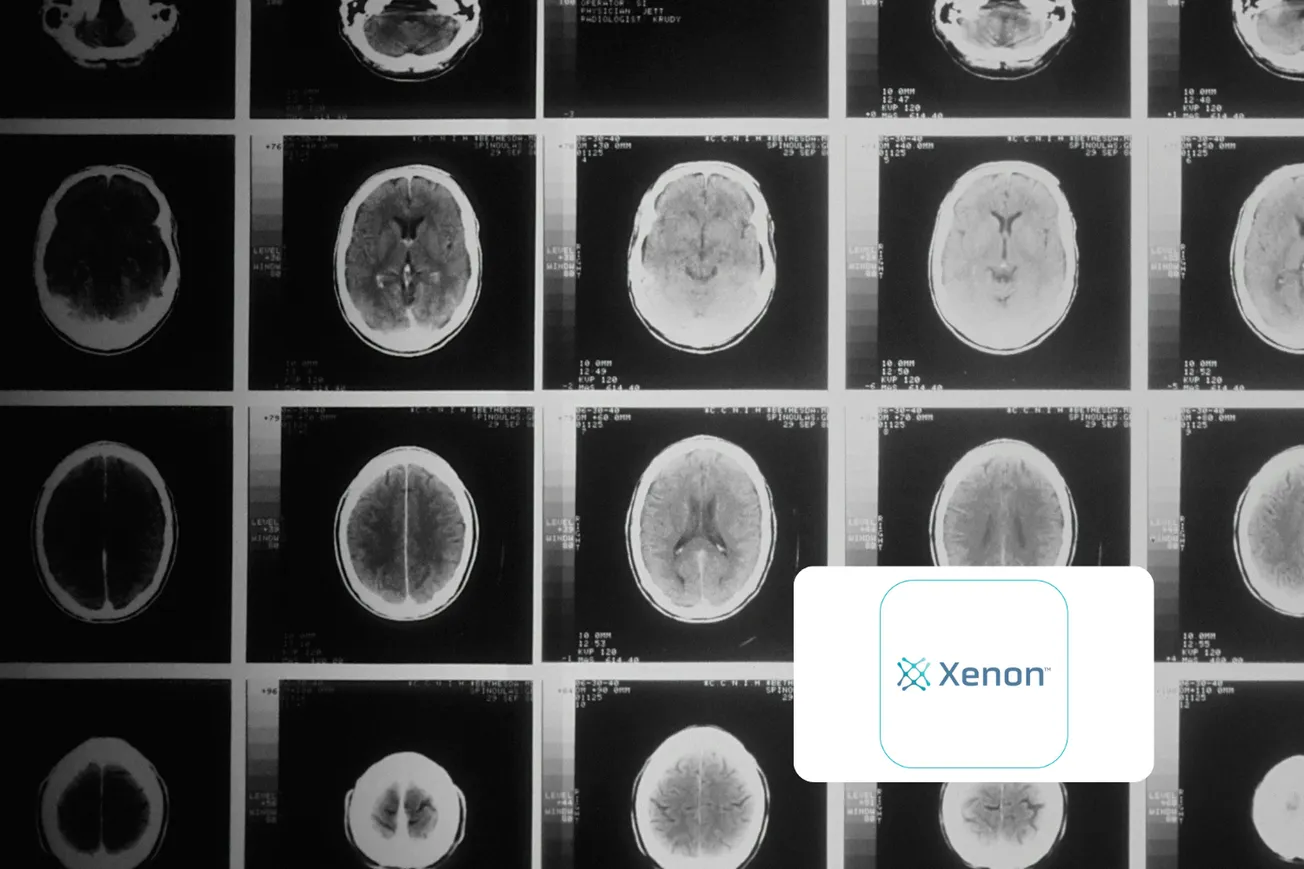 Xenon’s azetukalner meets Phase 3 endpoint in treatment-resistant focal onset seizures